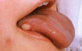 Нарост на языке во время беременности