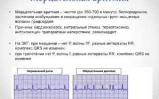 Мерцательная аритмия не лечится