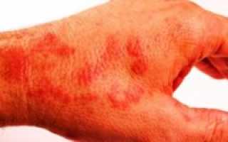 Чесотка / дерматит / аллергия ?