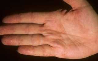 Дисгидроз кистей и стоп