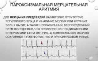 Мерцательная аритмия: пароксизмальная форма фибриляции предсердий-Эгилок или Беталок Зок?