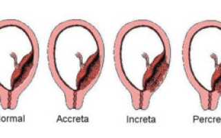 Врастание плаценты