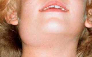 Воспаление подчелюстной слюнной железы