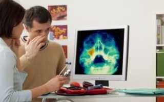 Диагностика хронического фронтита