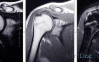 МРТ плечевого сустава