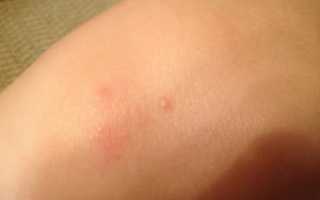 Водяной прыщ