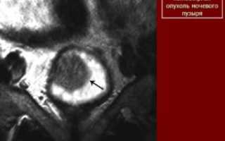 Может ли МРТ не показать опухоль мочевого пузыря