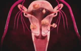 Миома матки