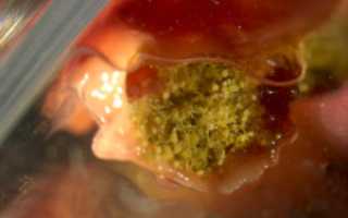 Чем лечить аспергиллез уха