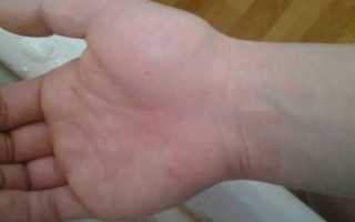 На ладони вздулась вена