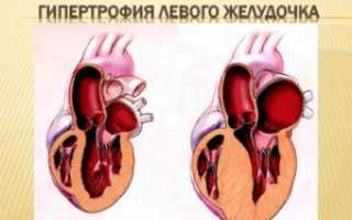 Что значит гиперкинез сердца?