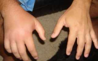 Частые переломы рук в одном и том же месте