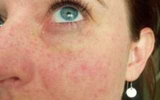 Мелкие пятна после аллергии