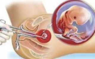 Чи можна завагітніти після першого аборту?