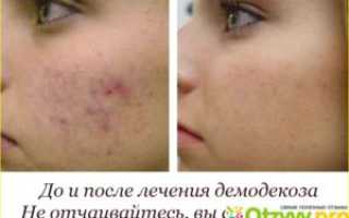Демодекоз у беременной