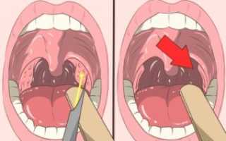 Нарост возле небного язычка