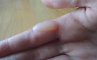 Волдыри на пальцах рук похожие на мозоли