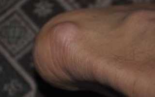 Мозоли и шишки на пятках