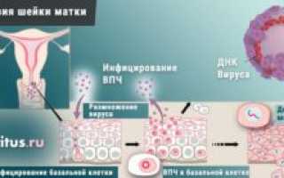 Дисплазия 1 степени, впч