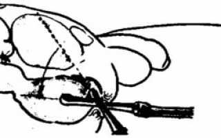 Наконечник клизмы остался в заднем проходе