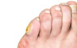 Мозоль на мизинцах