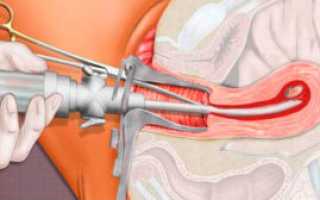Вакуумная аспирация
