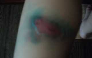 Воспаление пятен после укусов комаров