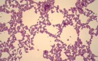 В мазке из зева обнаружили Staphylococcus aureus и Pseudomonas aeruginosa