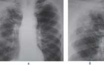 Метатуберкулезный пневмосклероз