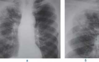 Метатуберкулезный пневмосклероз