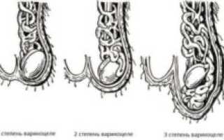 Высокая температура после операции на яичке