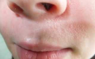 Мелкие прыщи на носу