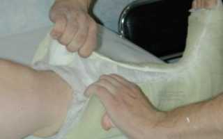 Через сколько можно снять гипс