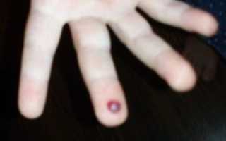 На пальце появился синяк
