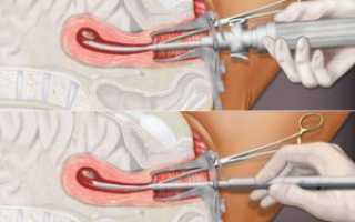 Чистка после фармацевтического аборта