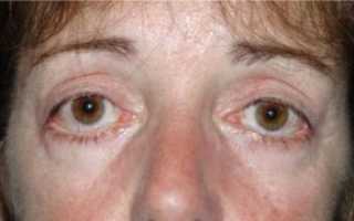 Диффузный зоб 2 степени АИТ