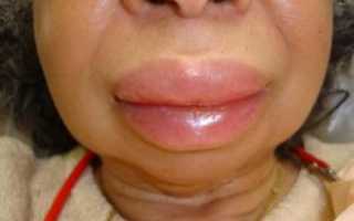 Крапивница, отек губы