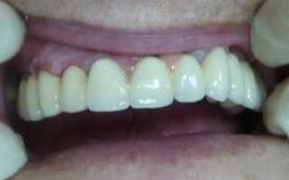 Металлокерамическая коронка на импланте может вызвать аллергию?