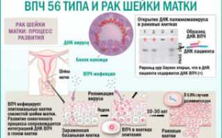 ВПЧ 56 тип и беременность