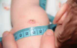 Делать ли прививку БЦЖ