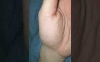 Дергается рука (нерв)