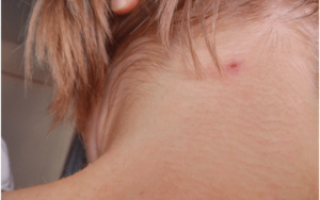 Чешется кожа головы и увеличены лимфоузлы