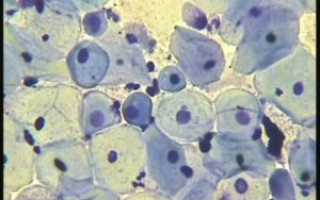 Воспалительный тип мазка, клетки МПЭ