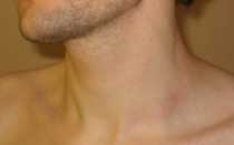 Надключичный лимфоузел