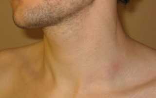 Надключичный лимфоузел