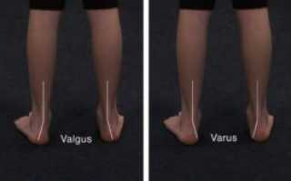 Варус или вальгус?