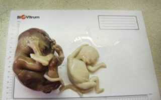 Выкидыш и 2 замершие беременности в браке