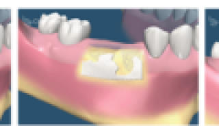 Косточка из десны?