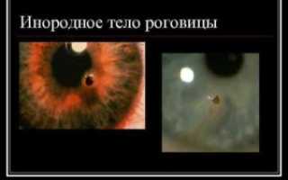 Длительность лечения после удаления инородного тела с роговицы