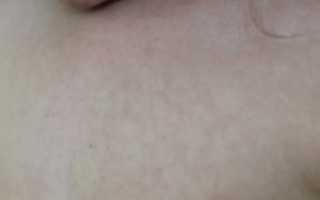 Еле заметная сыпь на теле